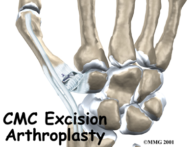 Excision Arthroplasty of the Thumb